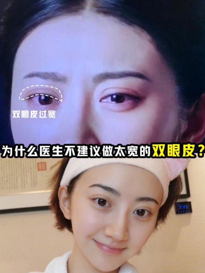 双眼皮割宽了怎么修复