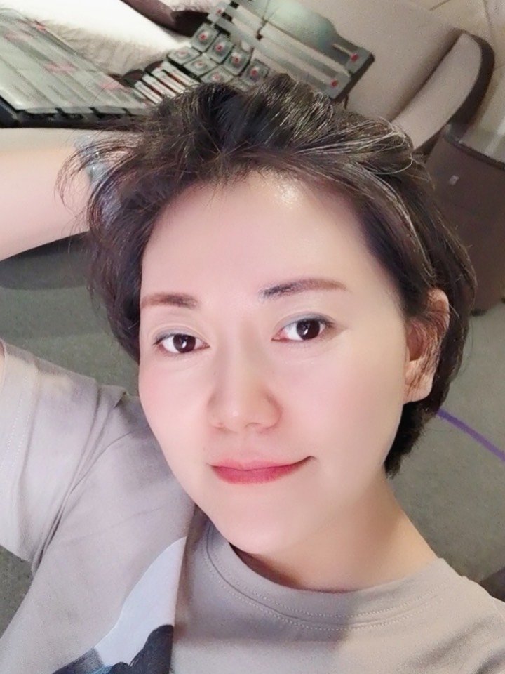 【 快四十岁的阿姨要年轻 】 做完埋线提升已经有四个月了快,线雕维持