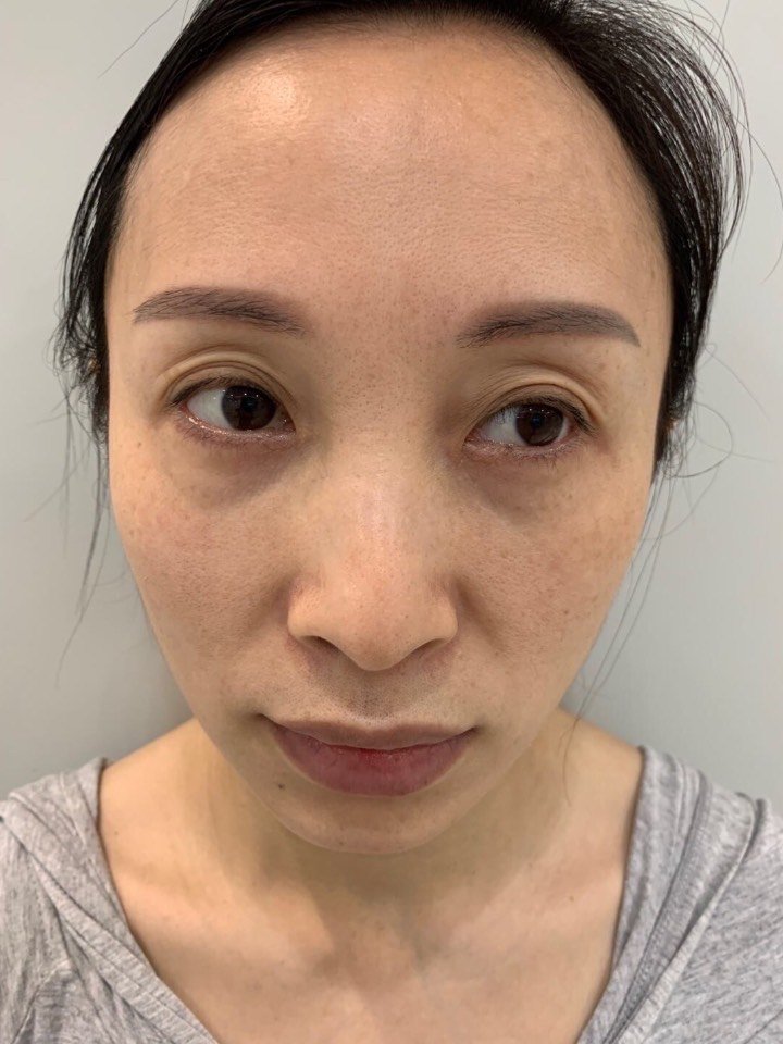 我上眼皮的皮肤特别松弛,很显老,而且很不喜欢那么多_圈子-新氧美容