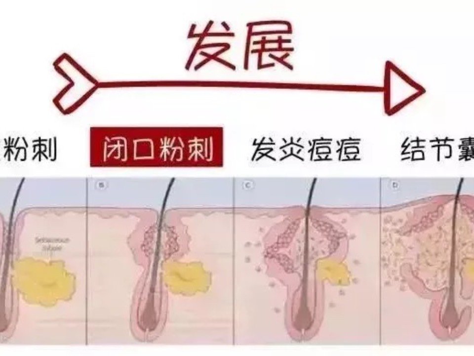 5个简单去除闭口粉刺小妙招