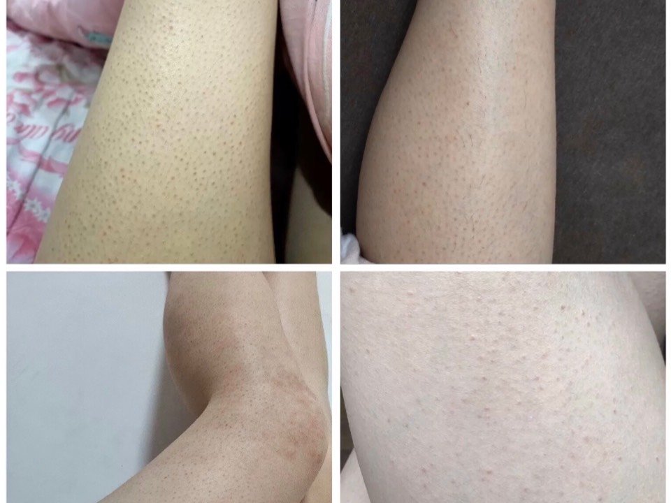 脖子上很多鸡皮肤(为什么脖子上有鸡皮肤)