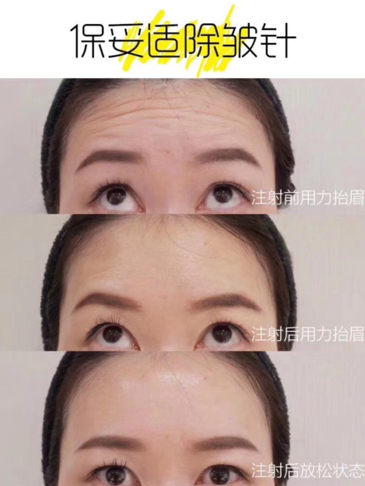 如何除皱针(除皱针操作视频教程)