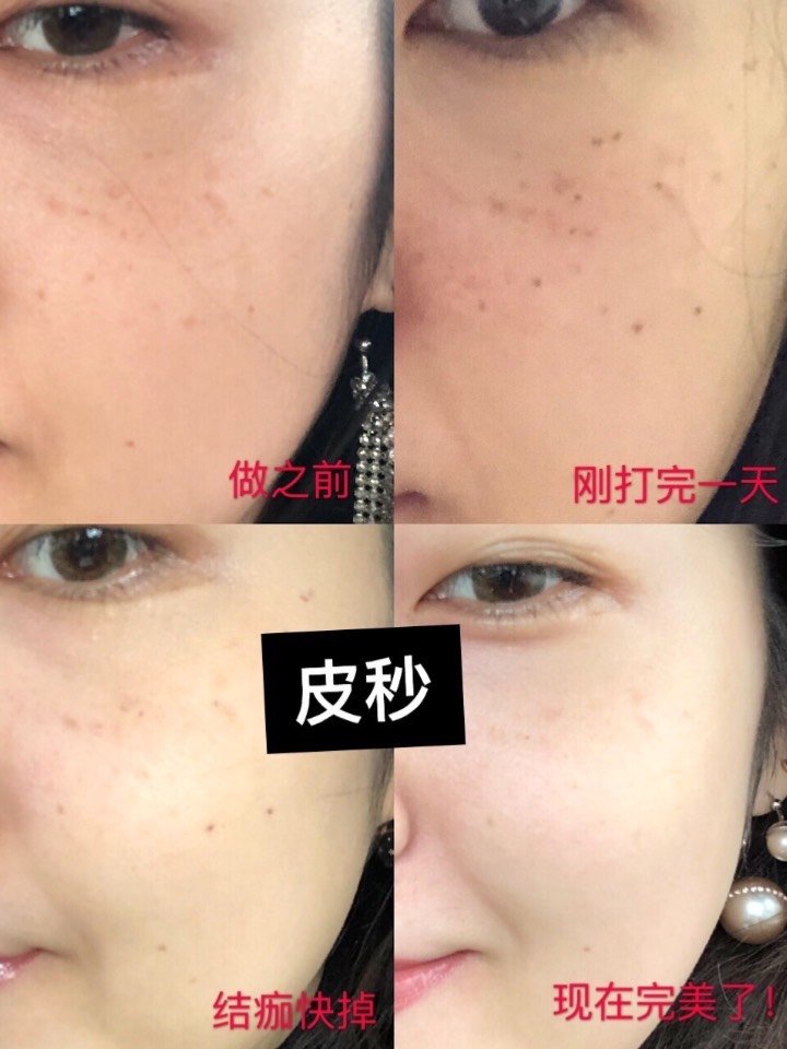 脸部斑点比较多,做了一个皮秒祛斑