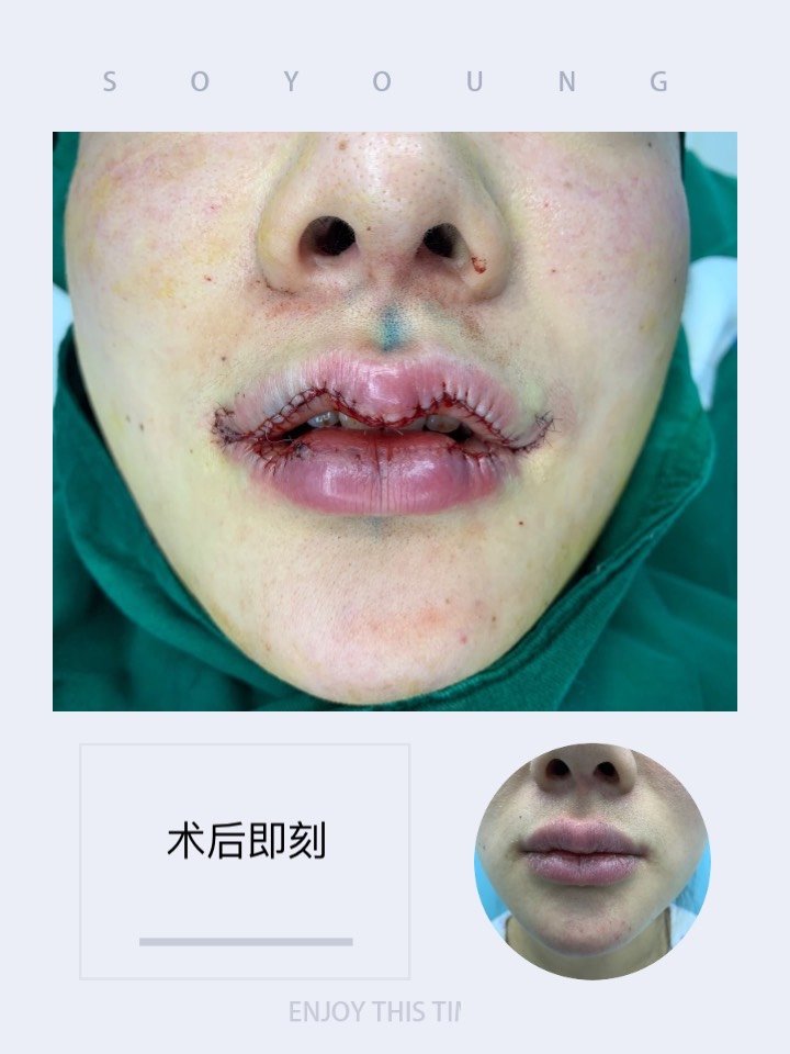 前后打了3次玻尿酸丰唇,这次终于下决心做唇手术了