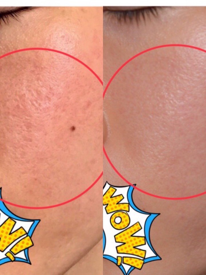 点阵激光可以改善皮肤哪些问题