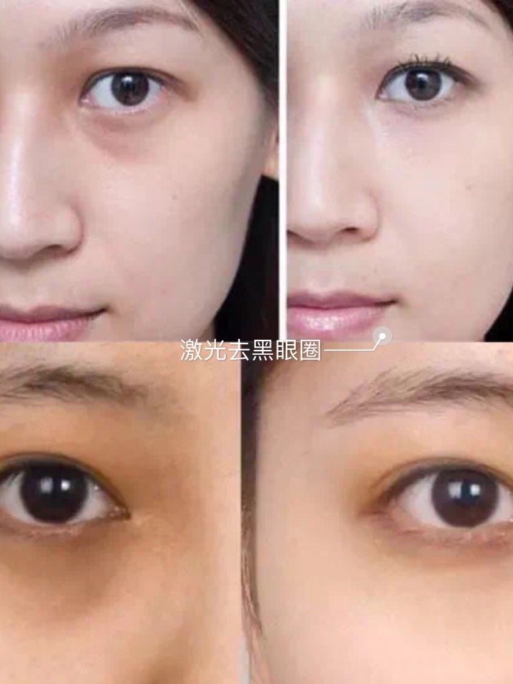 拯救黑眼圈计划