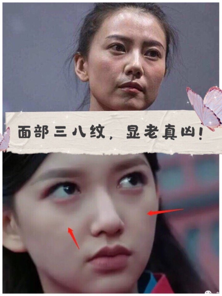 女明星都逃不过的面部三八线