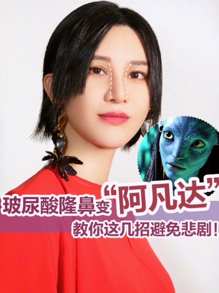 教你这几招避免玻尿酸隆鼻变阿凡达60