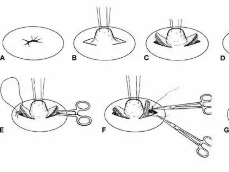 乳头凹陷矫正术的注意事项