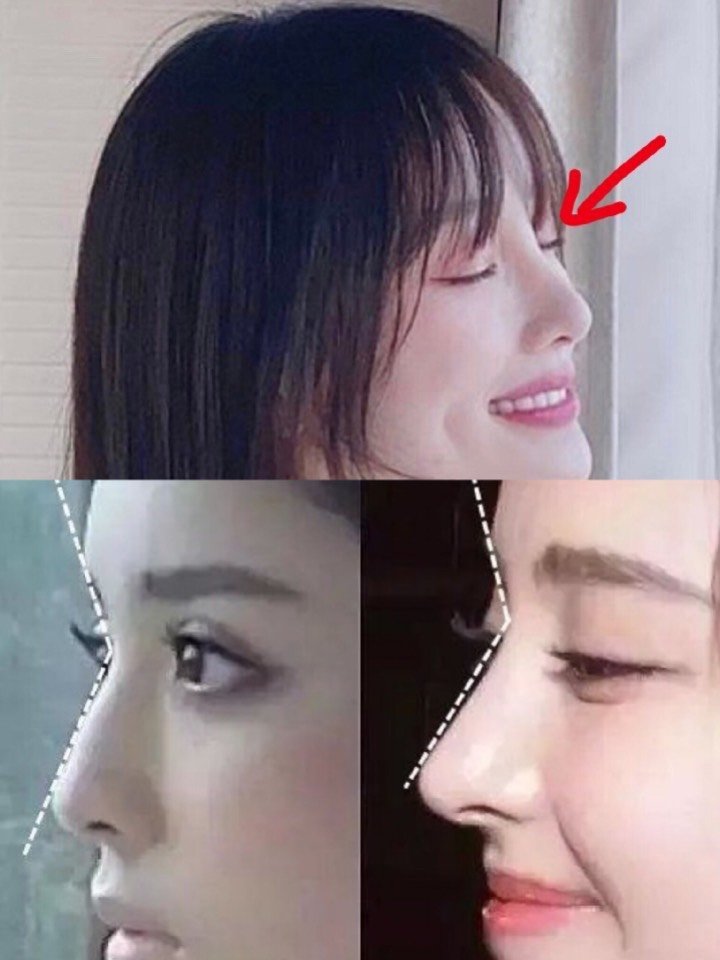 标准鼻额角为115°-130°,鼻额角越小,鼻子越_圈子-新氧美容整形