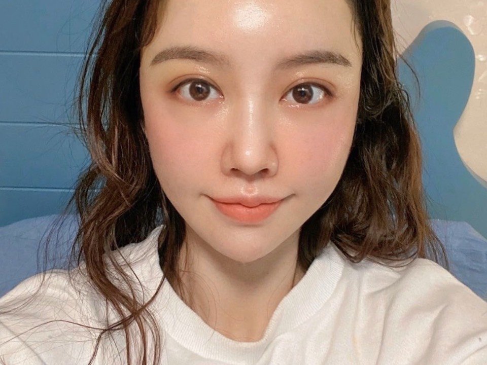 脂肪填充不到两个月 全切眼睑下至外眼角一个半月.