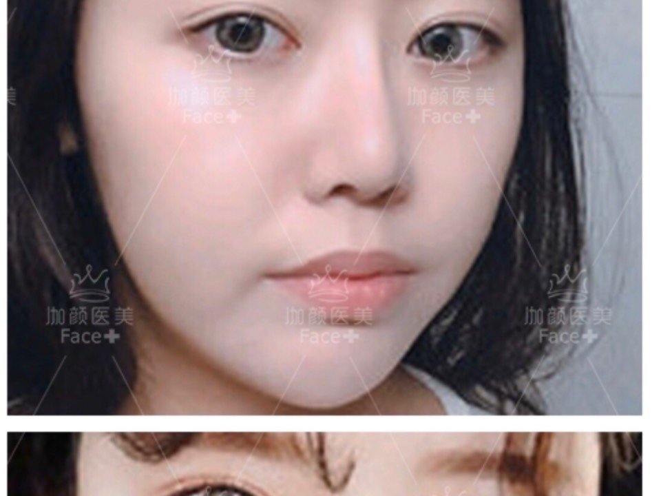 之前鼻子打了玻尿酸,变得好宽,这次来融掉,溶解酶真_圈子-新氧美容