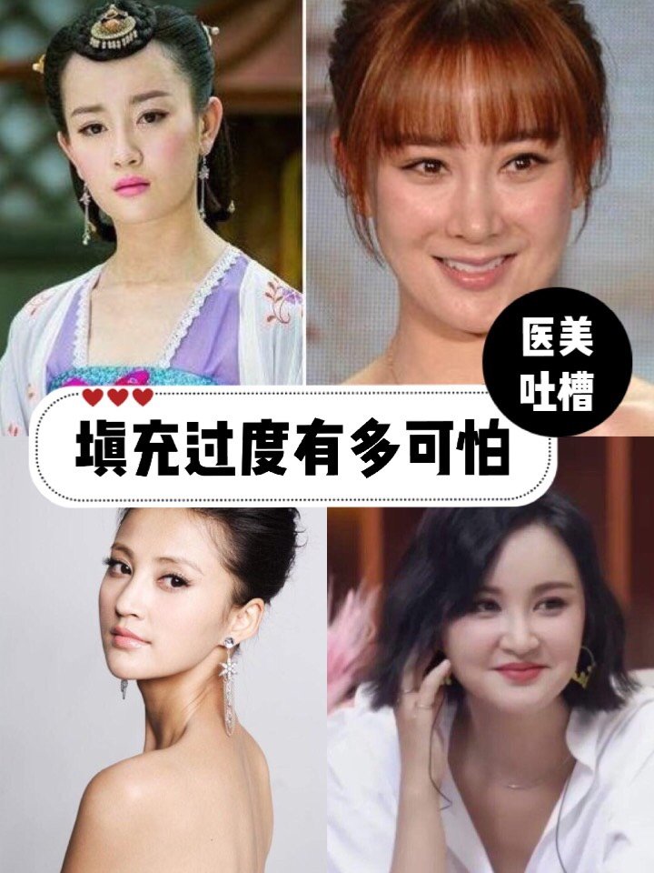 医美吐槽大会填充过度有多可怕71看看这些女明星就知_圈子-新氧