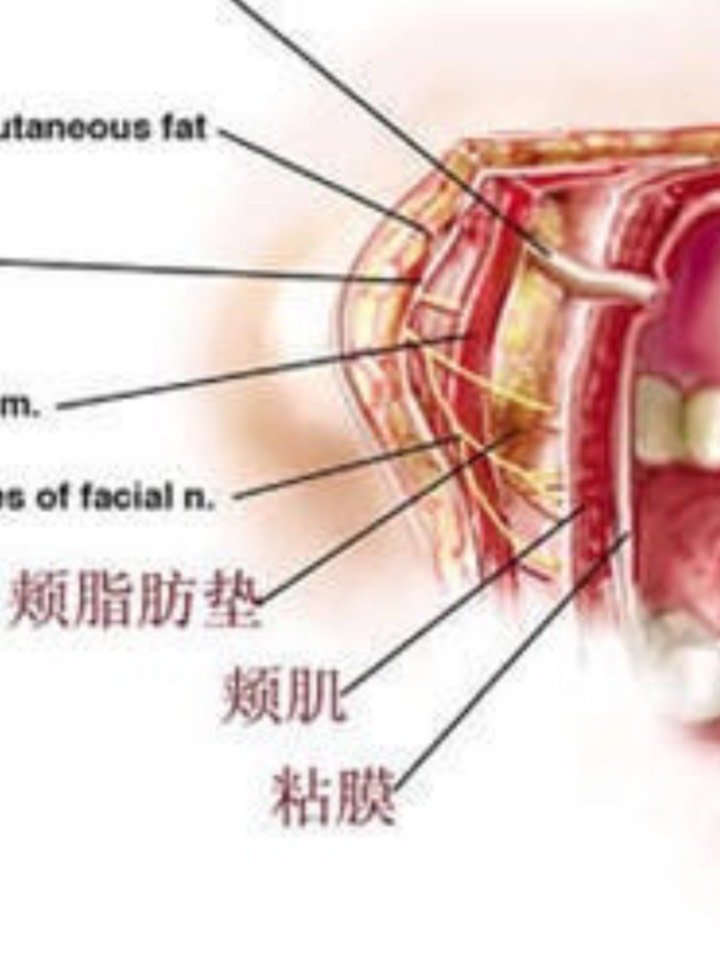 颊脂垫导致的面部肥胖是瘦不掉的!