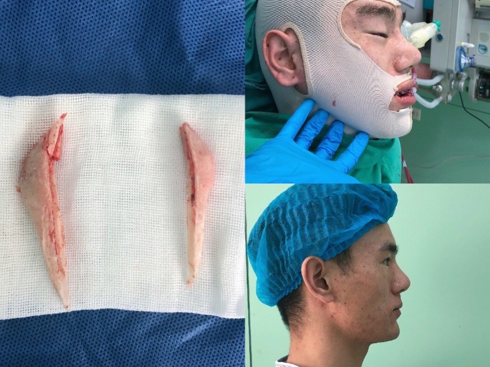 下颌角切除术后即刻对比