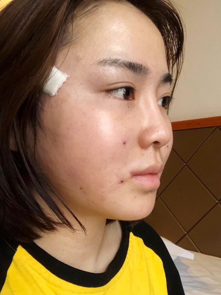 速愈美lt10线雕(术后第2天)