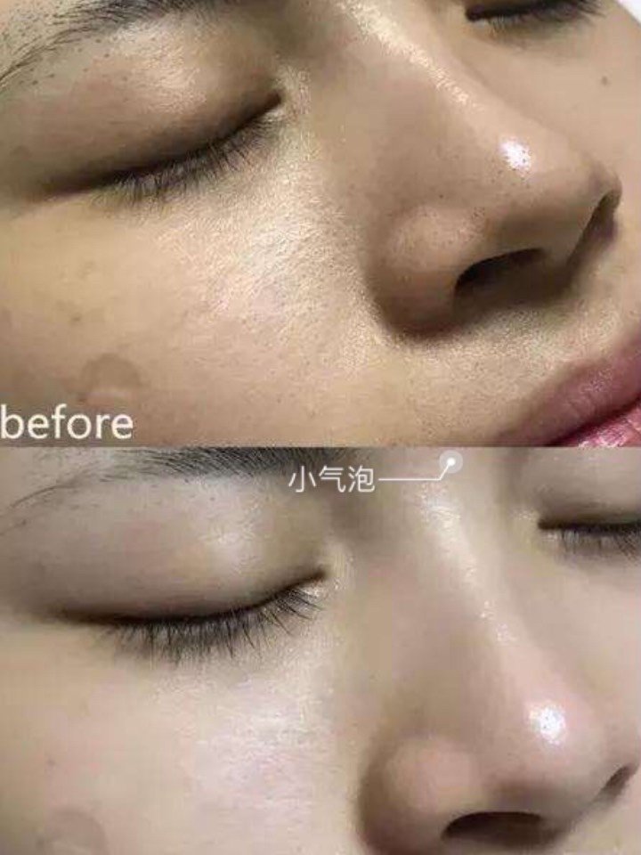 快速去黑头收缩毛孔医美攻略