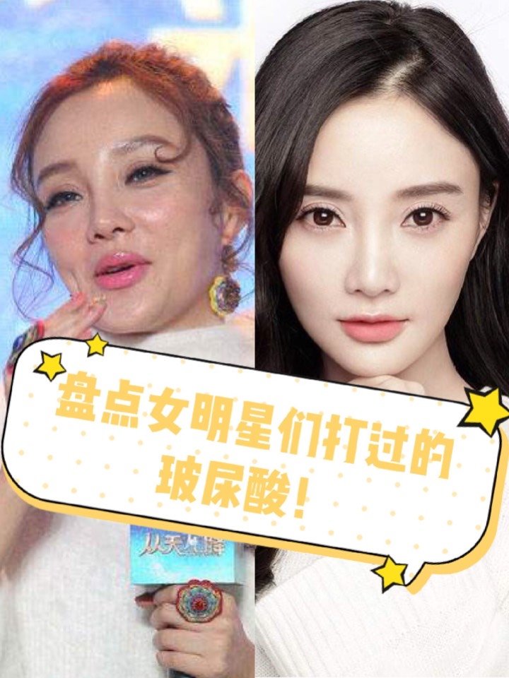 盘点女明星们打过的玻尿酸!