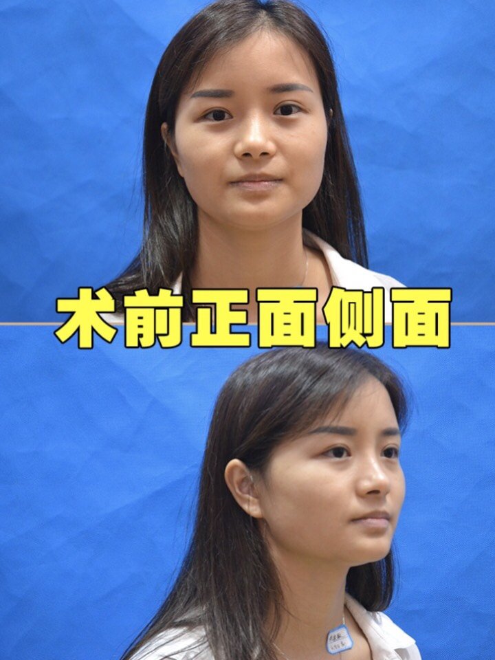 鼻基底填充假体后笑容会很僵