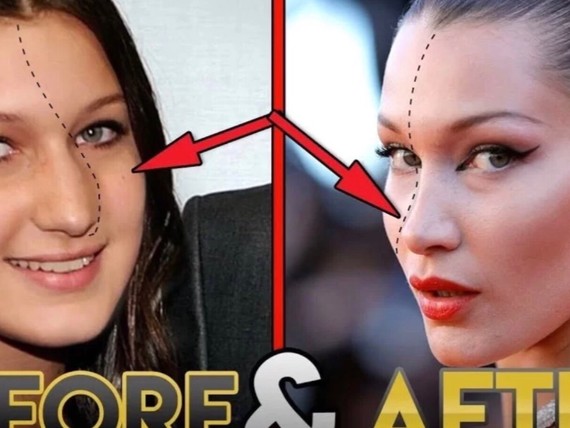 揭秘bella hadid整容史