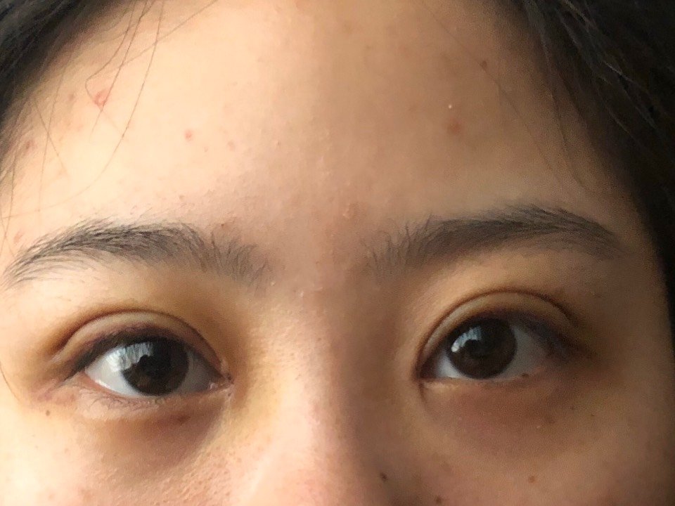 宁波美莱割的 眼角现在是不对称的 一个包住了 术后两三天就出现了的