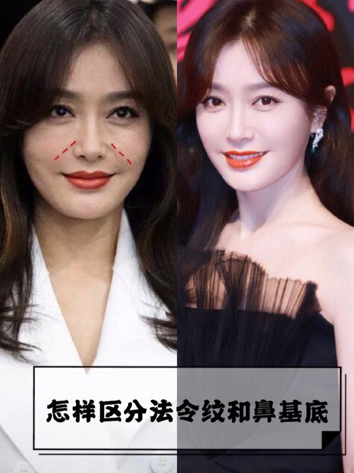 如何区分法令纹和鼻基底呢