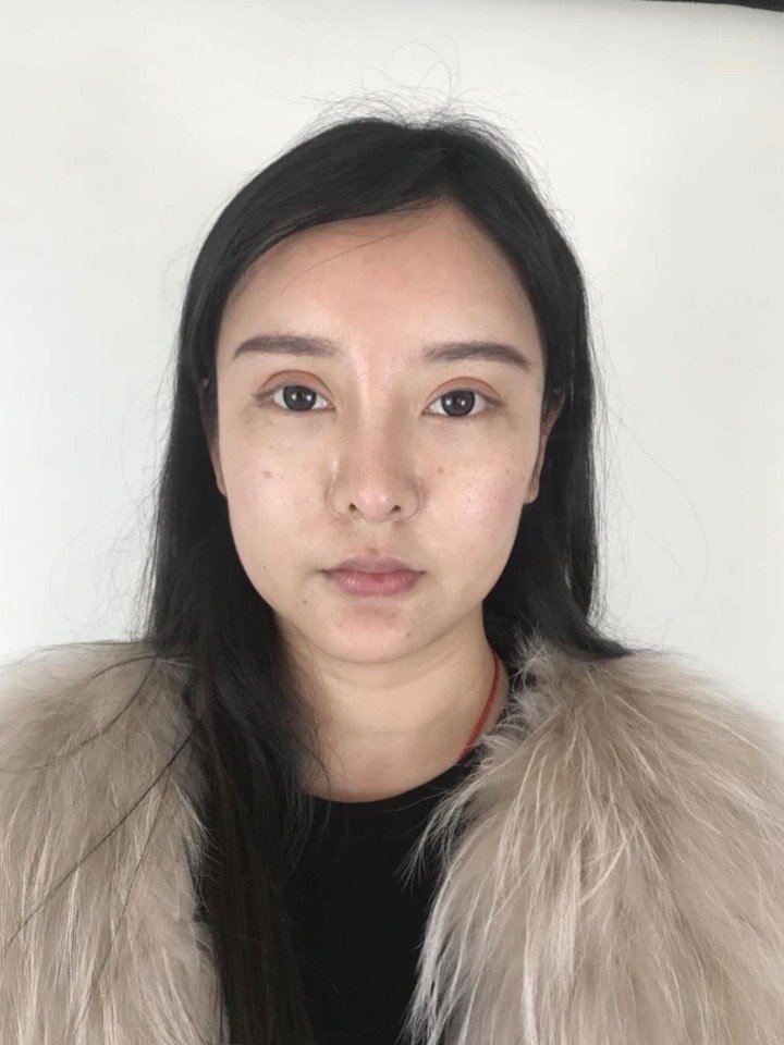 【买一赠一】【66双眼皮节】【假体垫眉弓】【原九院专家团队】【3项