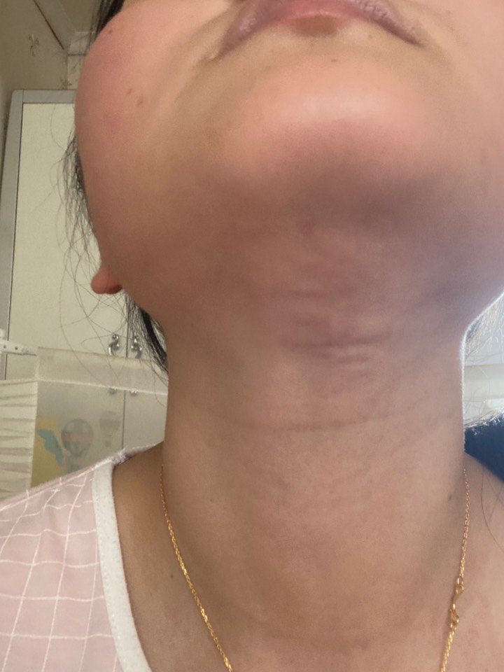 术后还有20天就到三个月了,双下巴吸脂后凹凸不平,_圈子-新氧美容整形