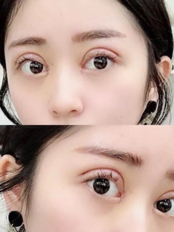 明明自己的肿泡眼已经做了双眼皮,可是为什么看起来还是又短又小又没