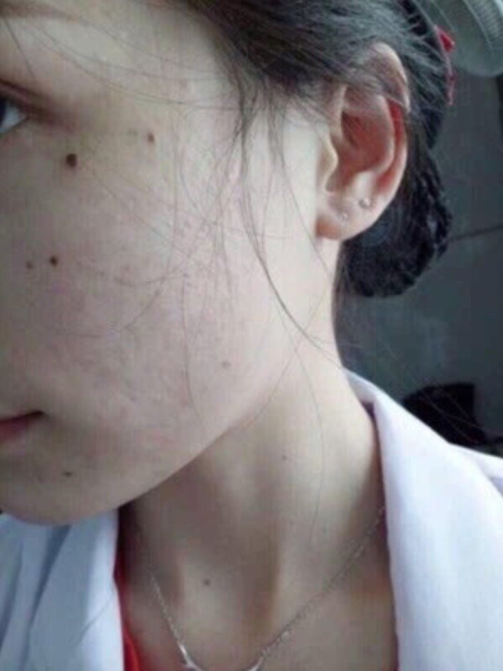 激光去痣 激光点痣结痂已经脱落了,脱落的时期也非_圈子-新氧美容