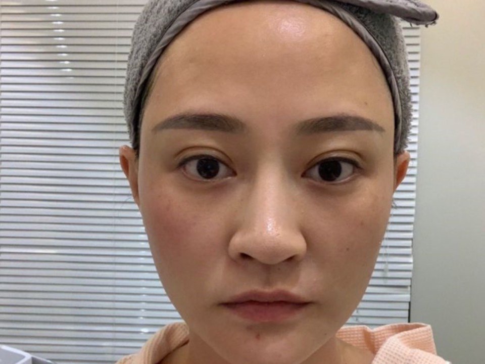 我的左脸比右脸肉,特别是嘴角肉肉有点下垂, 医生给我分配的发数左边