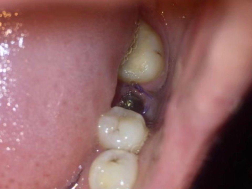 只有牙根的烂牙,由于年轻没有注重口腔,导致后来深龋整个牙都废了