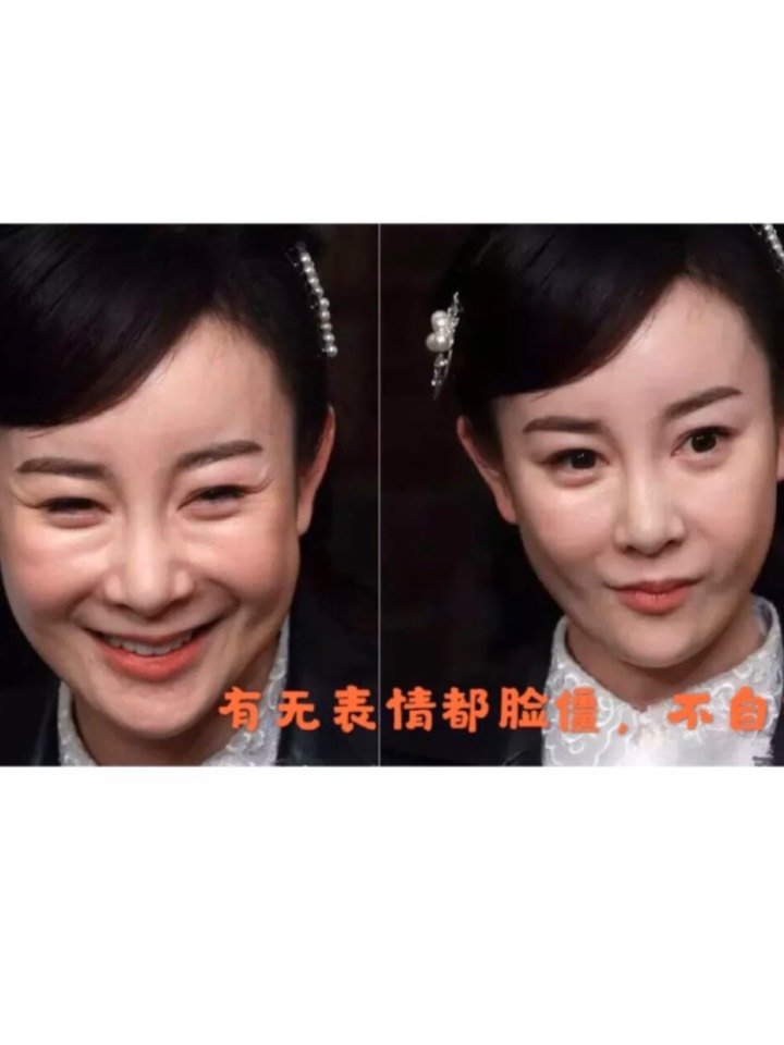 苹果肌是少女感的象征,它位于眼球正下方的位置,属于脂肪肌肉组织哦