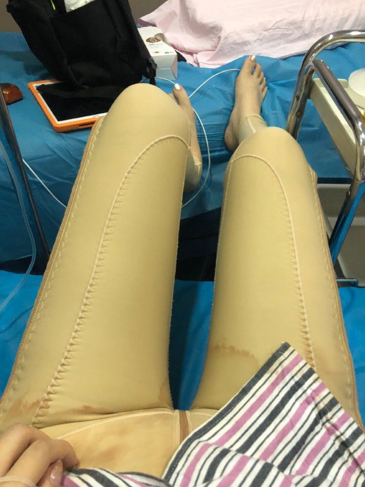 今天是腿部吸脂的第六天啦,昨天回医院换了一回要,无论是医生还是护士