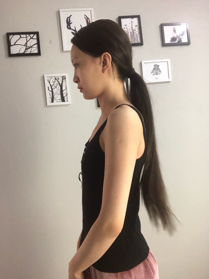 【假体隆胸】 进口曼陀假体丰胸 隆胸 日记返现打造深