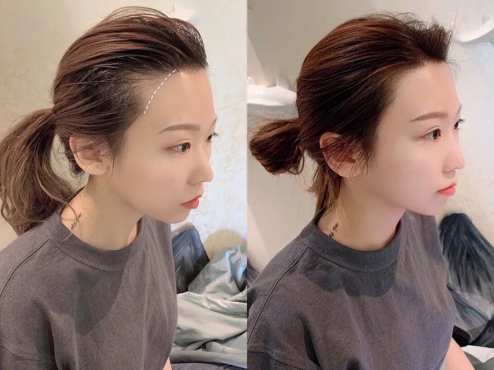 【半永久纹发际线】韩式半永久纹发际线 修饰额头 提升气质脸更小 纯