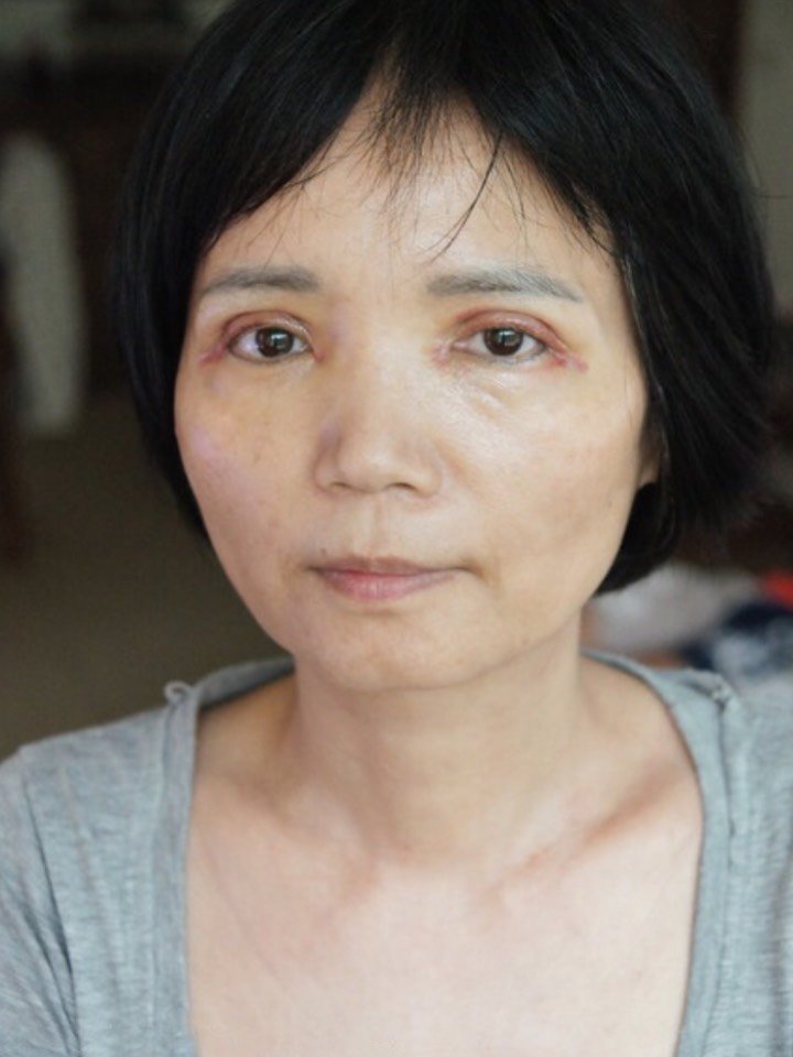 人到中年双眼皮离奇消失,眼皮下垂眼睛无神怎么破?