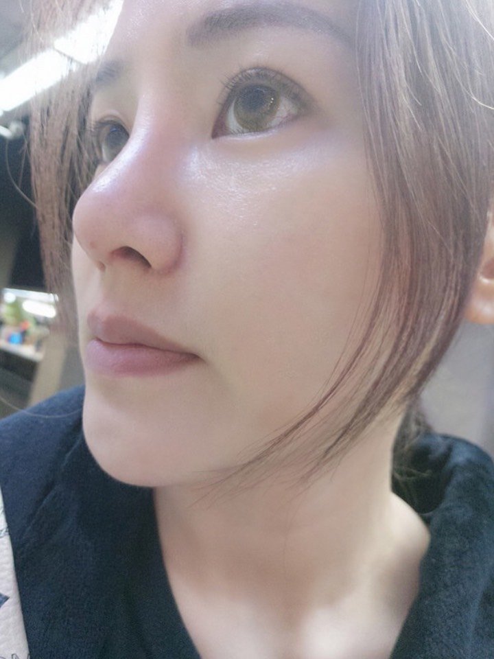 蒜头鼻改造记-2!鼻部多项术后恢复日记#隆鼻经历 #_圈子-新氧美容整形