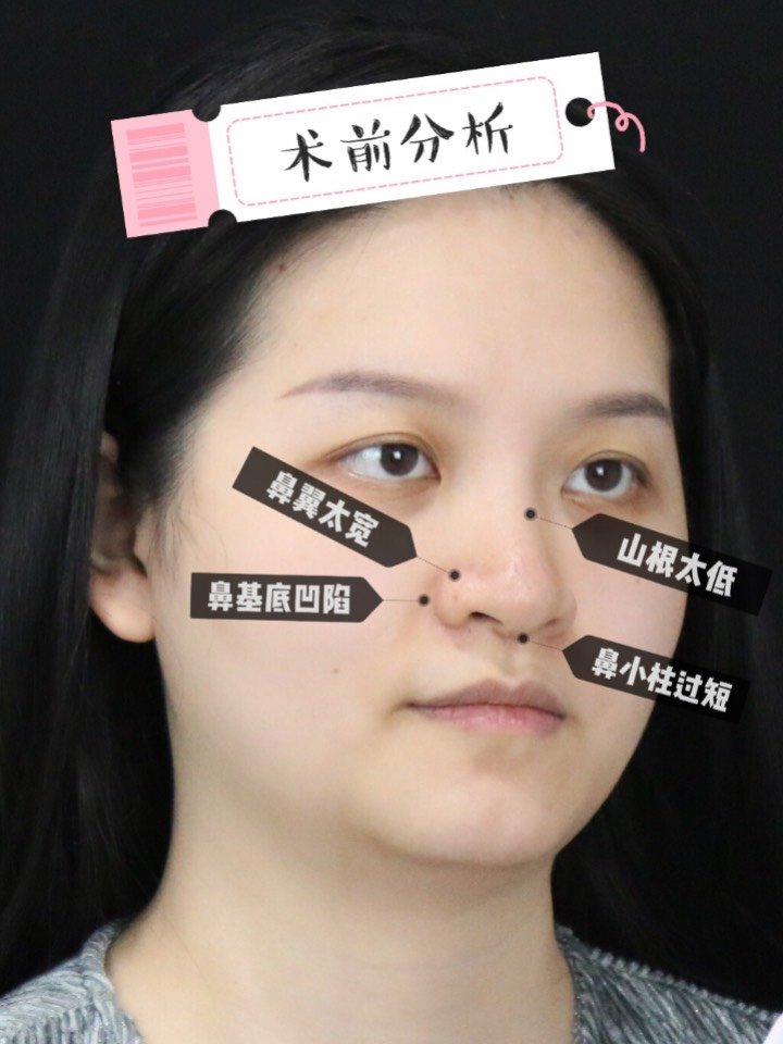 但是蒜头鼻太"毁"颜值了