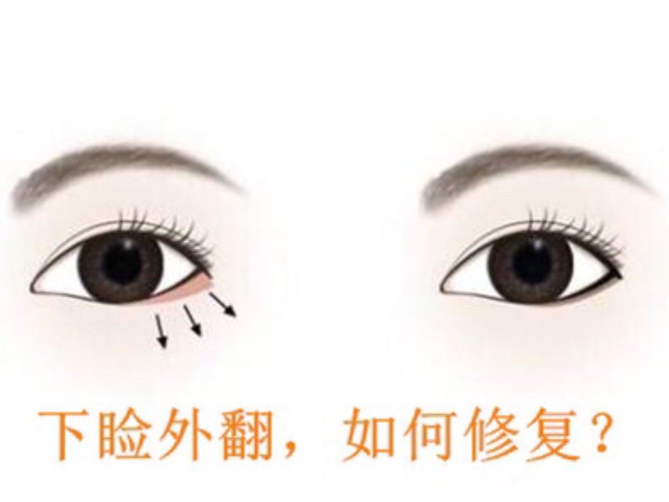 眼袋手术术后下睑外翻,如何修复?