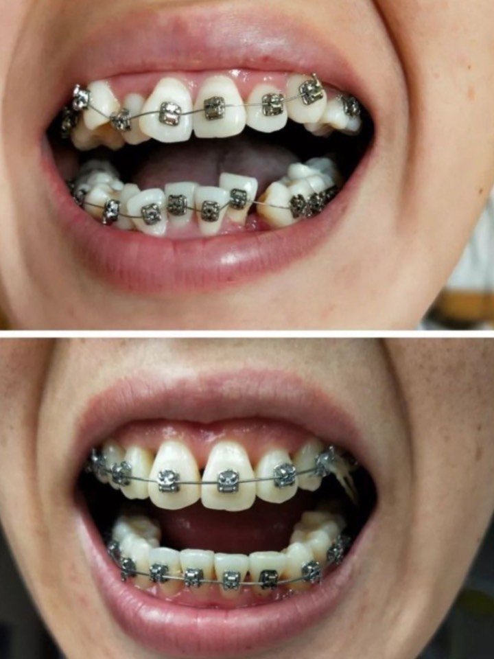 实在,没有过度营销,话很多,跟我说也不是市场推荐满的隐形牙套就一定