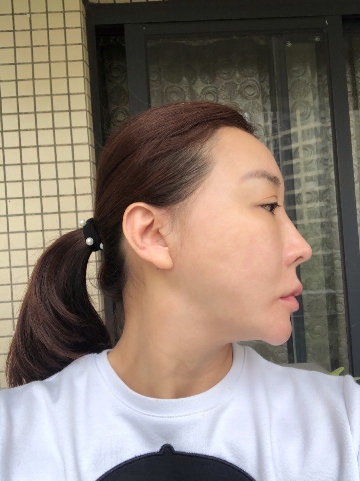 迷你拉皮术后反馈