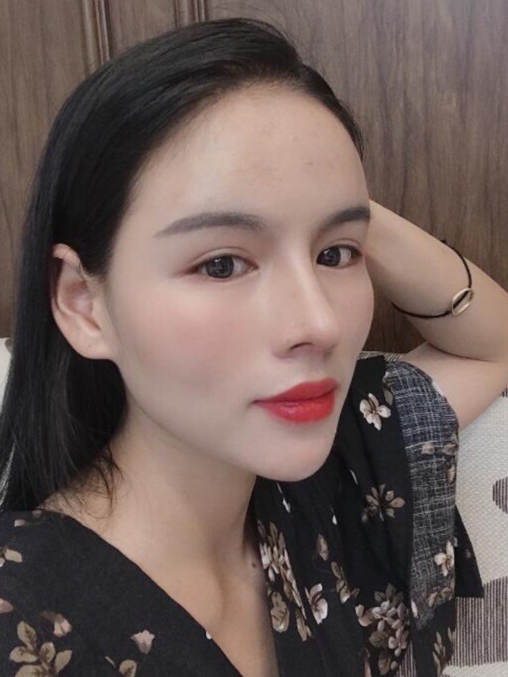 术后鼻型自然,高翘术后鼻尖可揉,可捏