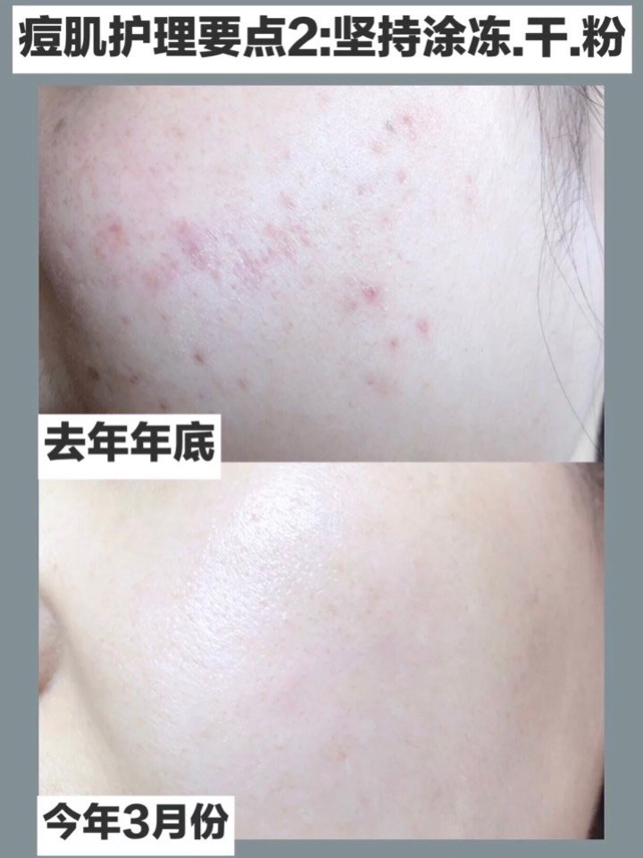 首页 此页面仅支持预览 Avatar 笨笨小仙女 264篇日记 日本流行 肌断食 去痘印 消痘 养成不长痘肤质坚持了8个月的肌断食护肤方法 现已 成功帮我摆脱了长 痘的烦恼 现在的皮肤真的是嫩到bao 何为肌断食 日本流程的护肤方式 就是给肌肤做减法 在皮肤