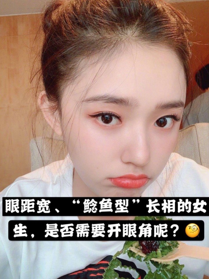 🍀🍀眼距宽,"鲶鱼型"长相的女生🍀,是否需要开眼角_圈子-新氧美