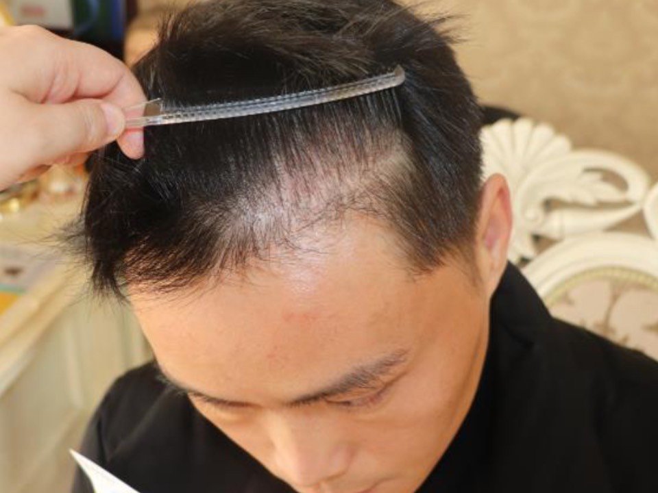 大麦微针植发··术后3年