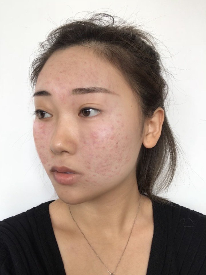 毕业后自己工作有钱了也想着把这种痘印脸拯救一下,对_圈子-新氧美容