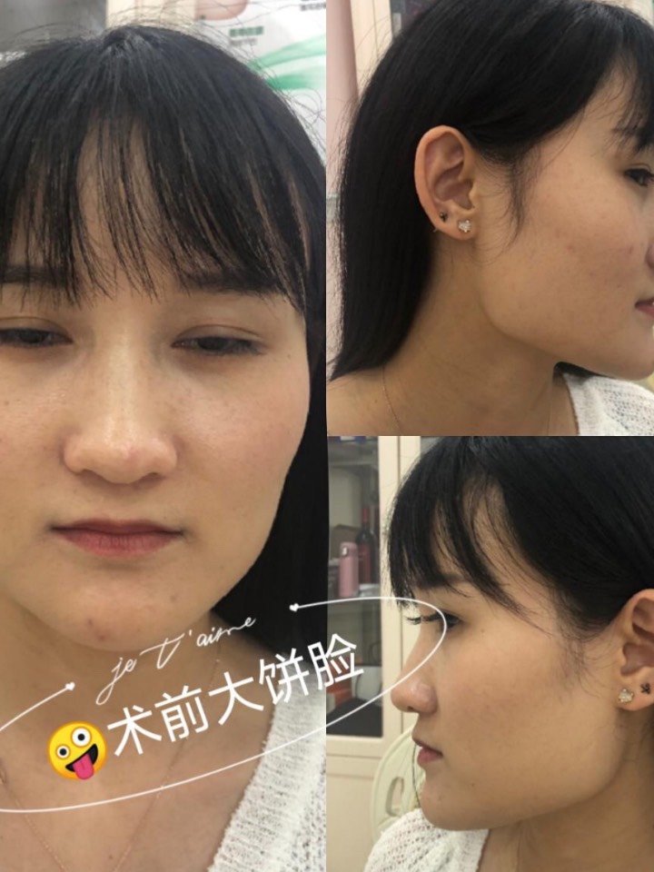 下颌角削骨整形3天就可以出院吗?