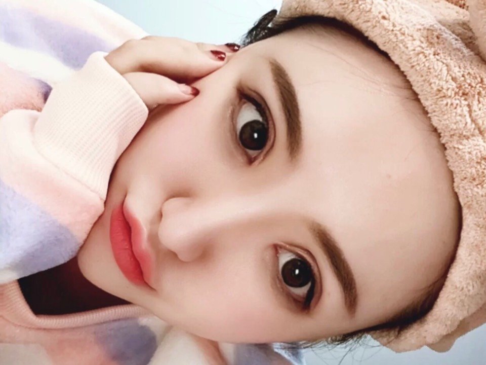 整容改变人生9 9393s芭比眼部多项手术(全切双眼皮 _圈子-新氧