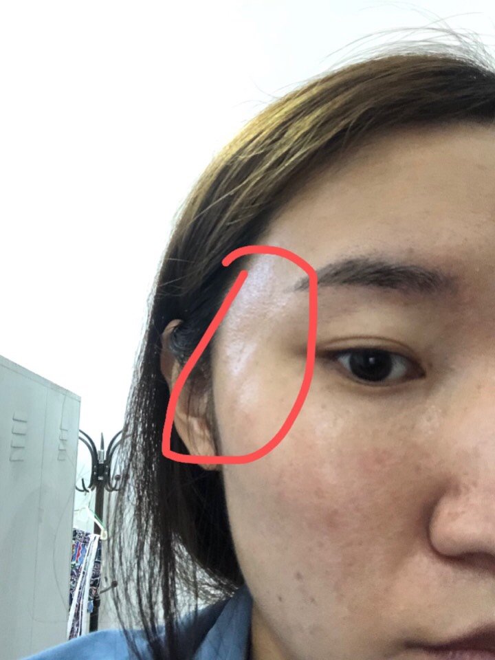 问了咨询师,说现在线还比较硬,可能睡觉蹭到了,把线锯齿给蹭起来挂到